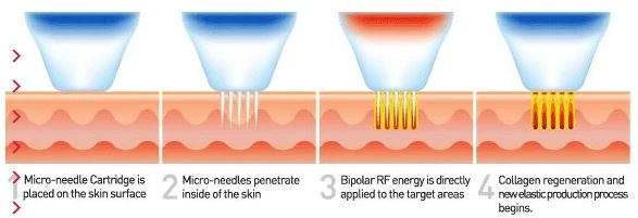 Vertical Fractional Rf Microneedle Scarlet Special Fractional Magic Effect Face Lift